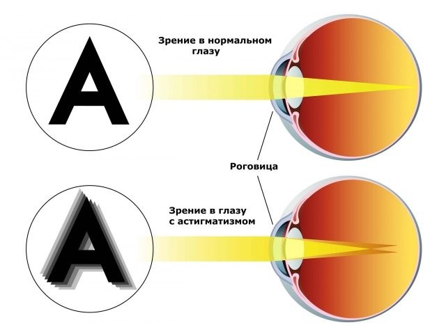 Как происходит освобождение по астигматизму на практике